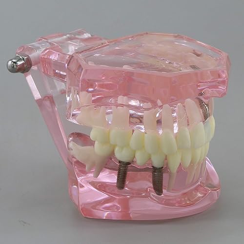 Miniatura 3 de Dental Dental Dental Modelo de Dientes de Restauración de Implantes Puente Demostración Enseñar Estudio Patología Oral Typodont para Enseñar Estudio