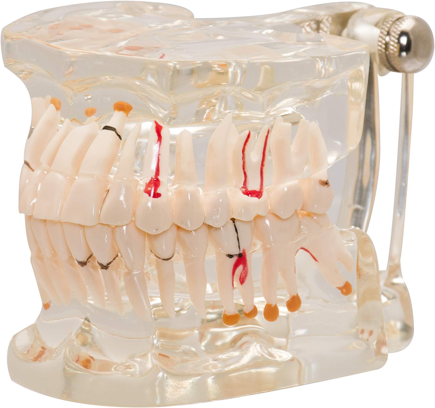Premium Dental Model, Normal Dentition and Occlusion, Affected Side Shows Multiple Pathologies, Made of Yellowish Transparent High Quality Unbreakable Acrylic, Showing Roots