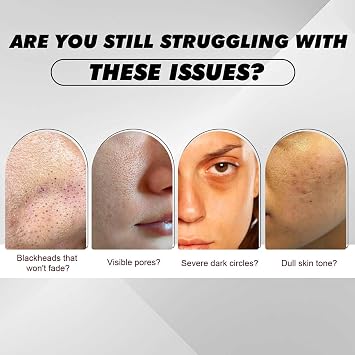 TXA Alpha Arbutin Serum with Tranexamic Acid-Alpha-Arbutin Discoloration Serum,Anti-pigmentation Serums for Dark Spots,Remove Blemishes,Acne Marks&Tanning,Korean Skincare,50ml