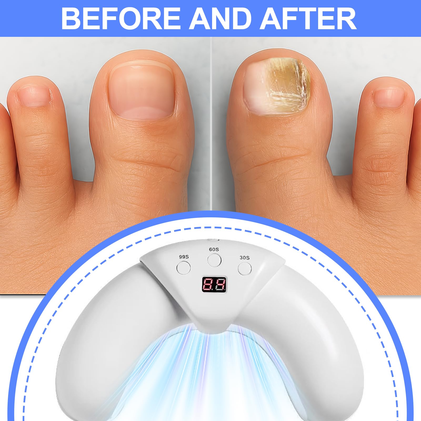 Appareil laser contre les champignons des ongles - Pour plusieurs ongles des mains et des orteils - Pour ongles endommagés et décolorés