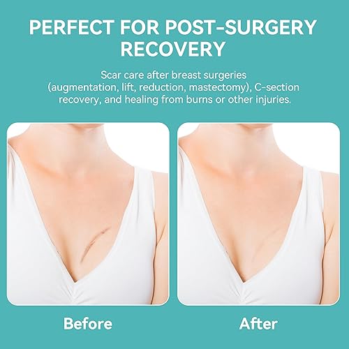 Miniatura 5 de Hojas de silicona para cicatrices de mama  6 parches en forma de anclaje  Silicona de grado médico, hipoalergénica y reutilizable para levantamiento