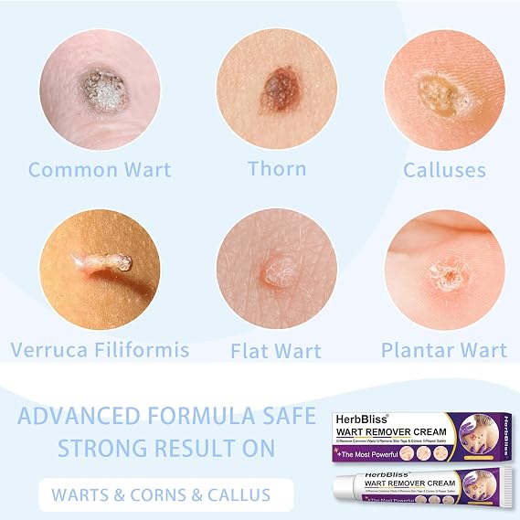 Wart Remover Cream, Wart Removal Cream for Verruca, Plantar Warts, Common Warts, Flat Warts (20g)