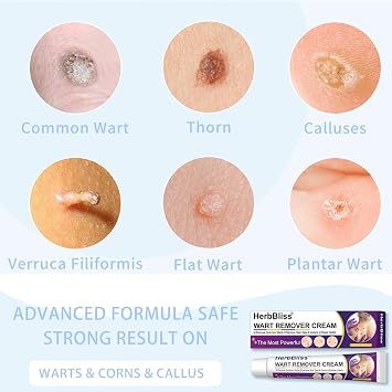 Wart Remover Cream, Wart Removal Cream for Verruca, Plantar Warts, Common Warts, Flat Warts (20g)