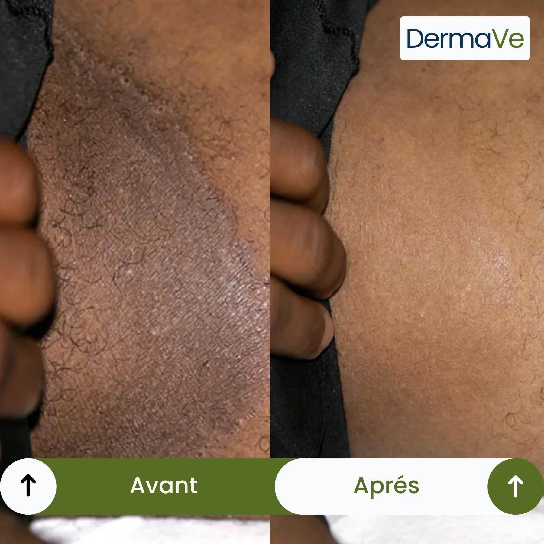Savon antifongique Dermave Savon solide purifiant huile d'arbre à thé – visage et corps pour peaux à problèmes, nettoie en profondeur, régule le sébum, parfum frais