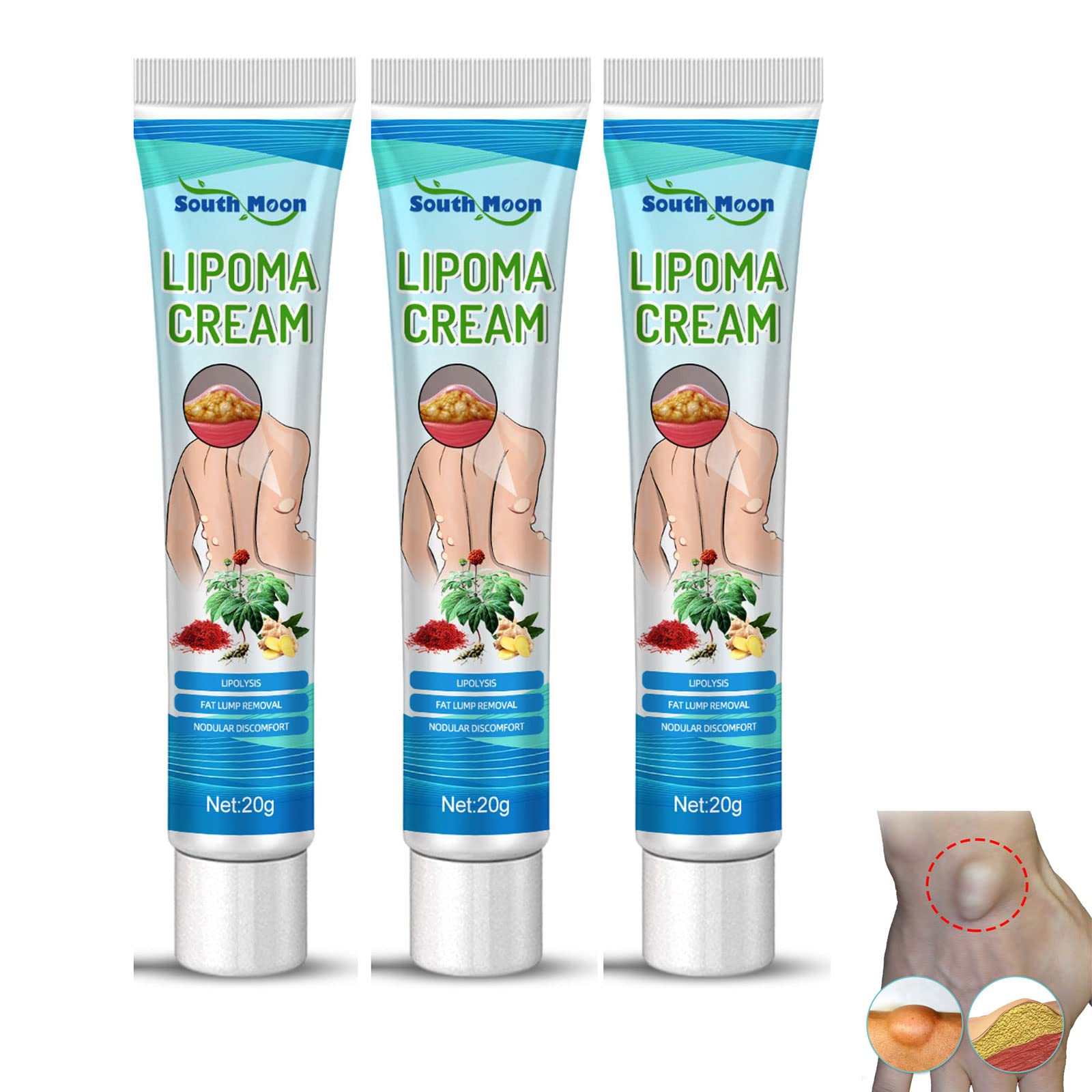 Buy Lumpfree Lipoma Removal Cream, South Moon Lumpfree Lipoma Removal