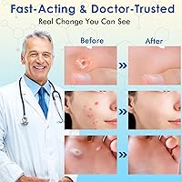 Vista 3 de Eliminador de verrugas con 17% de ácido salicílico, removedor de marcas cutáneas de acción rápida, tratamiento líquido para verrugas comunes