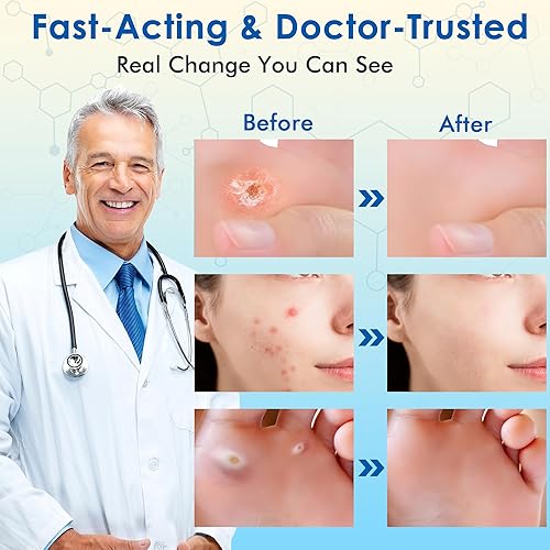 Miniatura 3 de Eliminador de verrugas con 17% de ácido salicílico, removedor de marcas cutáneas de acción rápida, tratamiento líquido para verrugas comunes y