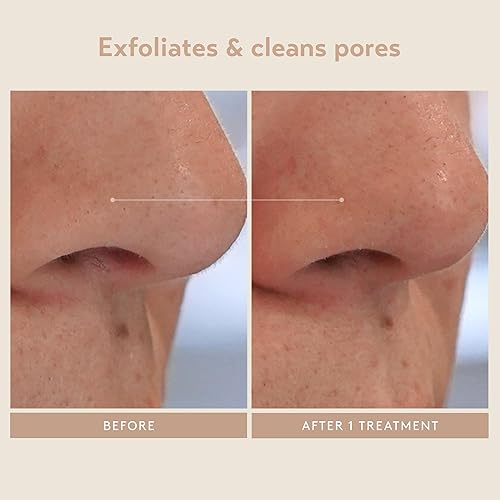 Miniatura 8 de SHANI DARDEN SKIN CARE Triple Acid Peel, 2-Step Exfoliating Face Peel with Mandelic, Lactic & Glycolic Acids, Kaolin Clay Neutralizing Mask & Brush