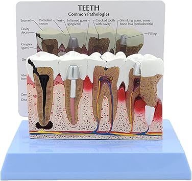 Dental Teeth Model, Human Teeth Anatomy Model, Pathology Demonstration Dental Model with Instructions for Dentist Office Educational Tool