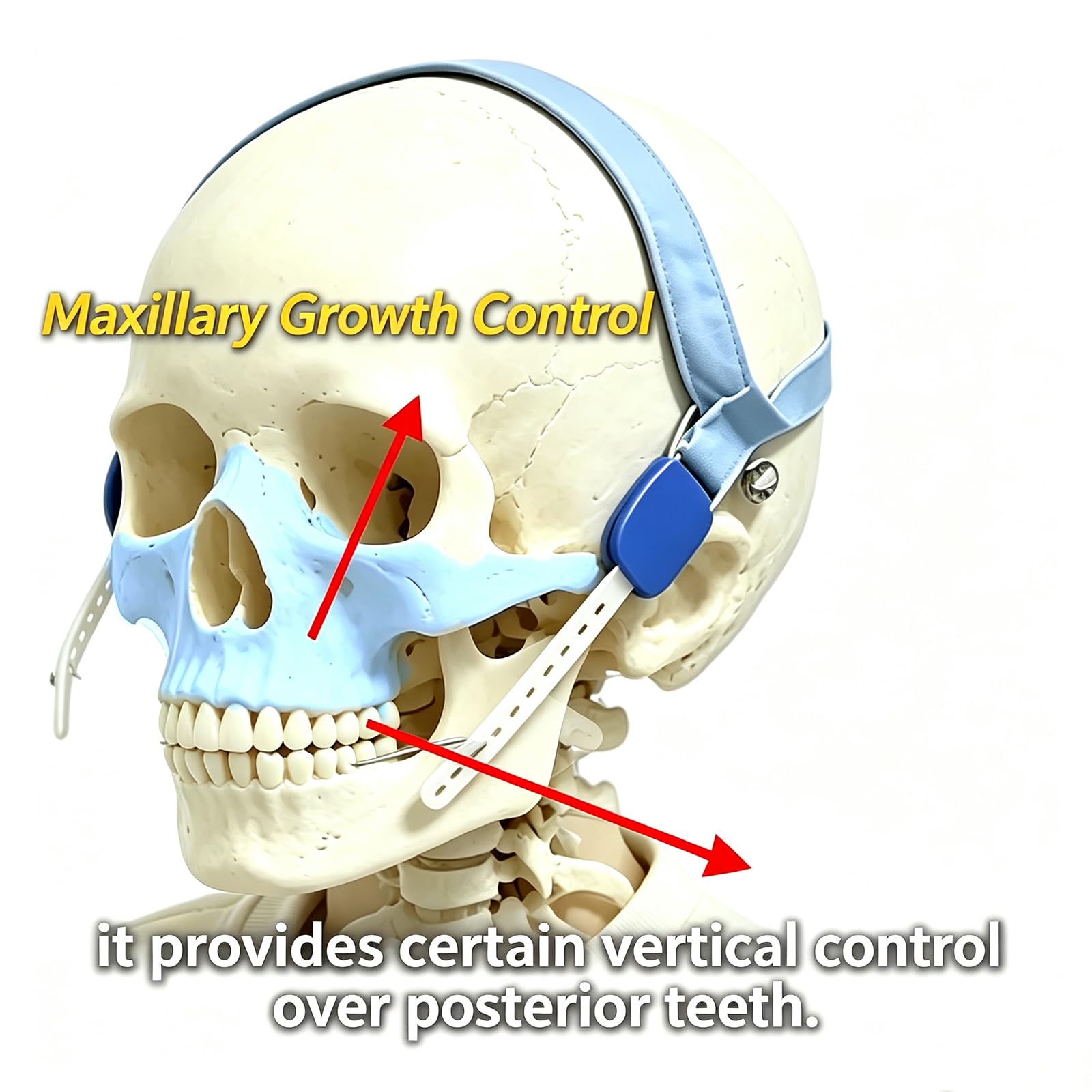 Appareil Orthodontique De Traction Extra-orale Avec Arc Externe - Dispositif De Traction Mandibulaire Pour Décubitus Latéral, Sans Déformation, Idéal Pour La Couverture Du Sol Et Le Soutien De La