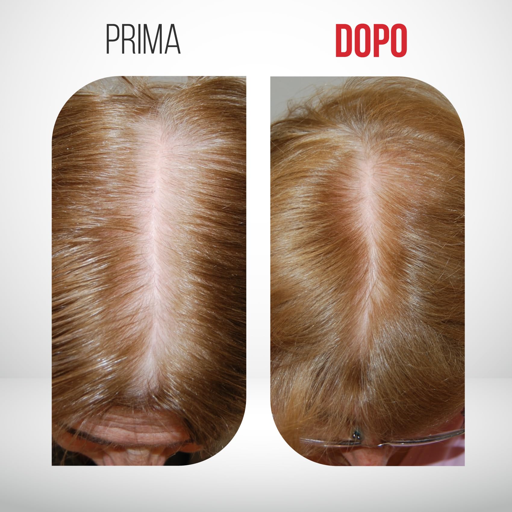 Restax Lozione Donna 100ml anticaduta fortificante capelli alopecia androgenetica femminile