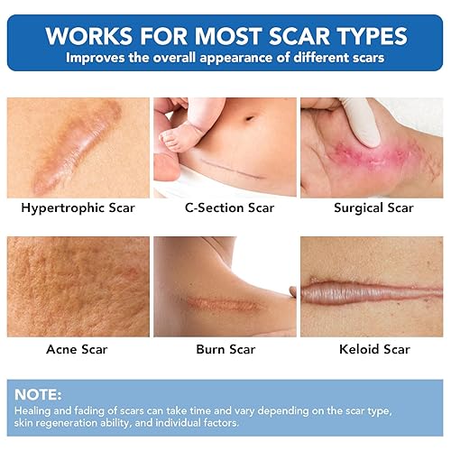 Miniatura 2 de Hojas de silicona para cicatrices, cinta adhesiva de silicona (rollo de 1.6 x 60 pulgadas - 4.9 ft), cinta adhesiva reutilizable, suave y de grado