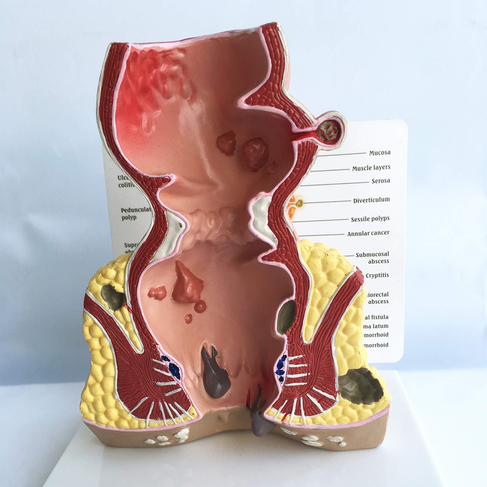 Modell Der Menschlichen Rektalen Pathologie, Modell Der Rektalen HäMorrhoidenpathologie, Modell Der Menschlichen Rektalen Anatomie, Medizinische Lehrmittel