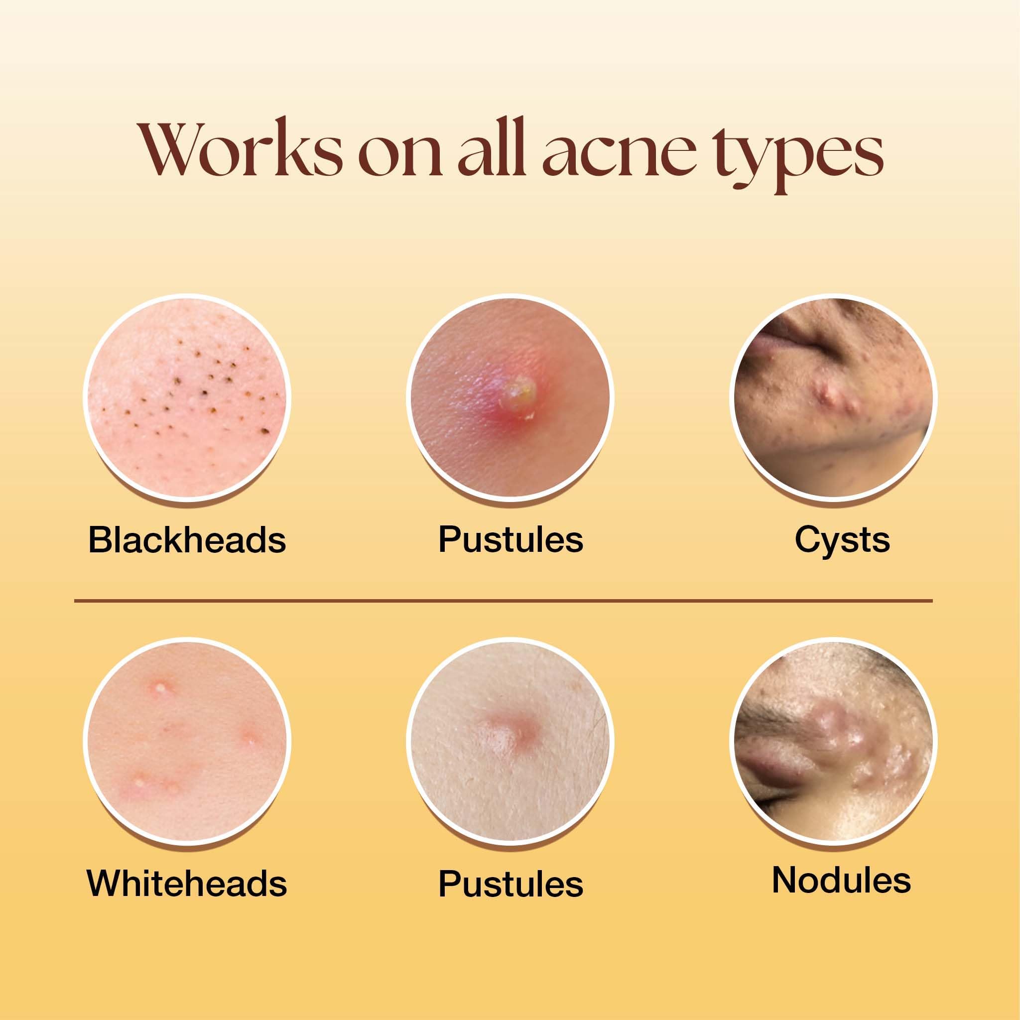 Siya Ayurveda Acne Spot Corrector Gel For Reducing Active Acne |1% Niacinamide and 2% Salicylic Acid Reduces Pimples, Blackheads, & Whiteheads 2