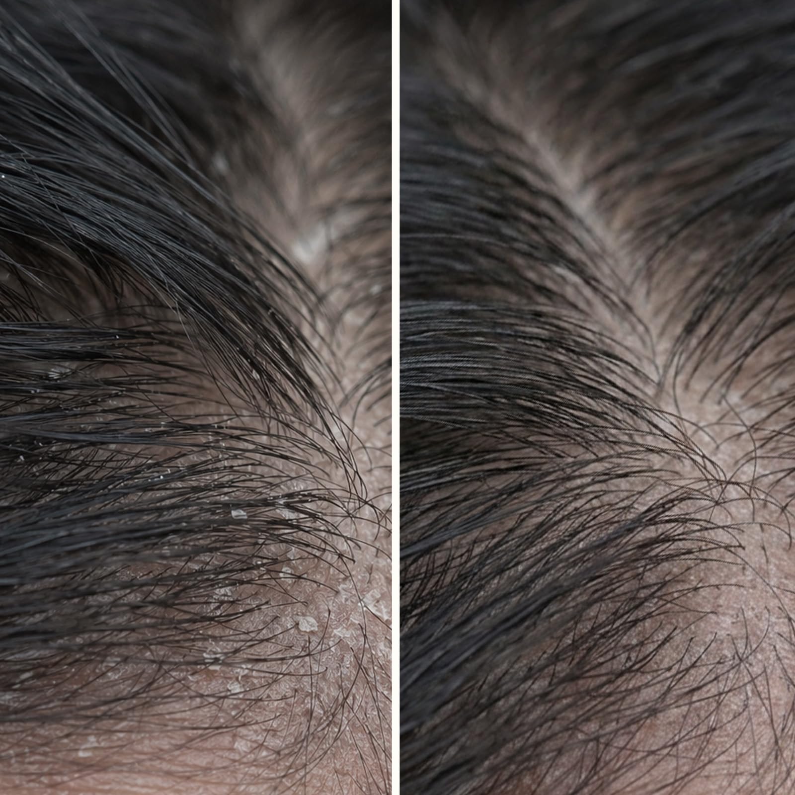 Peeling Cuoio Capelluto all'Acido Salicilico contro Forfora, Prurito & Secchezza - Trattamento Pre-Lavaggio 10 Minuti Esfolia & Pulizia Profonda con Acido Salicilico & Piroctone Olamine - 150 ml