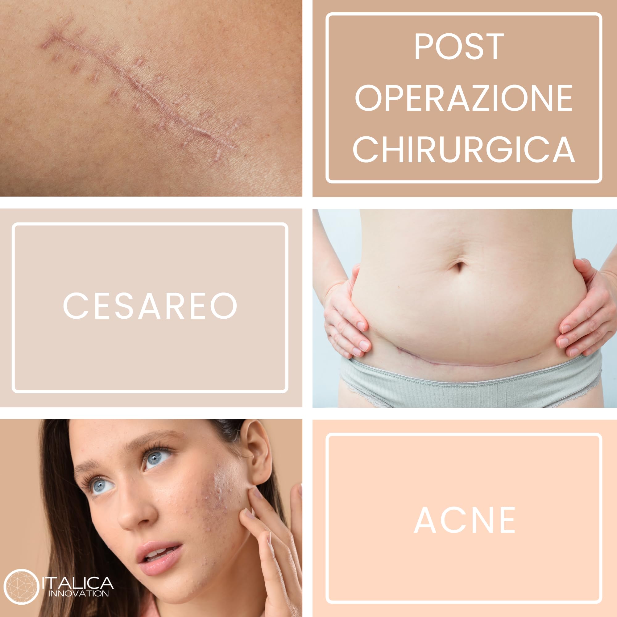 Cerotti in Silicone per Cicatrici, 4x300cm, Ipoallergenici e Riutilizzabili, Impermeabili Post Operatorio, per Cicatrici Chirurgiche, Cesareo, Acne e Cheloidi