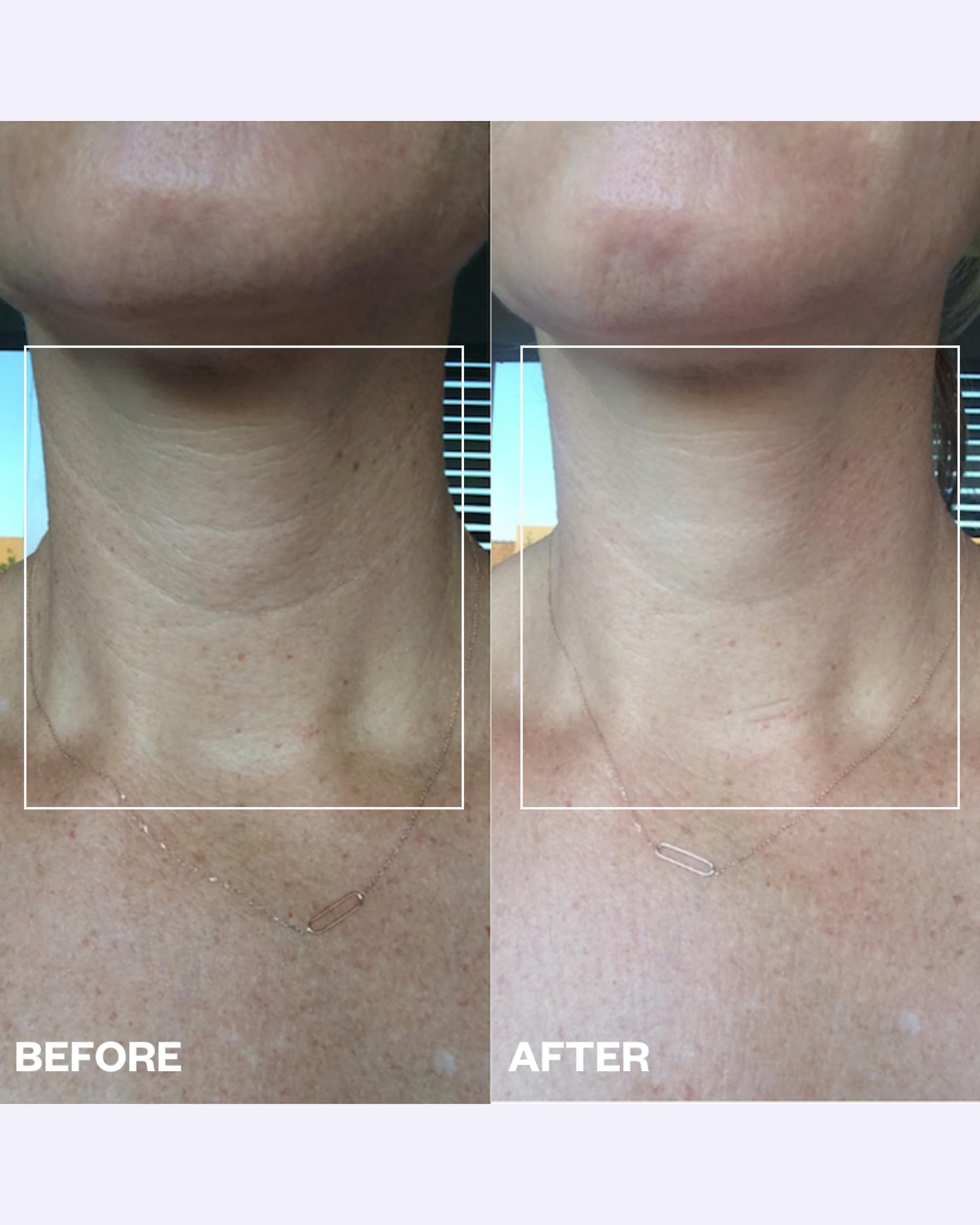 Kit para suavizar el cuello