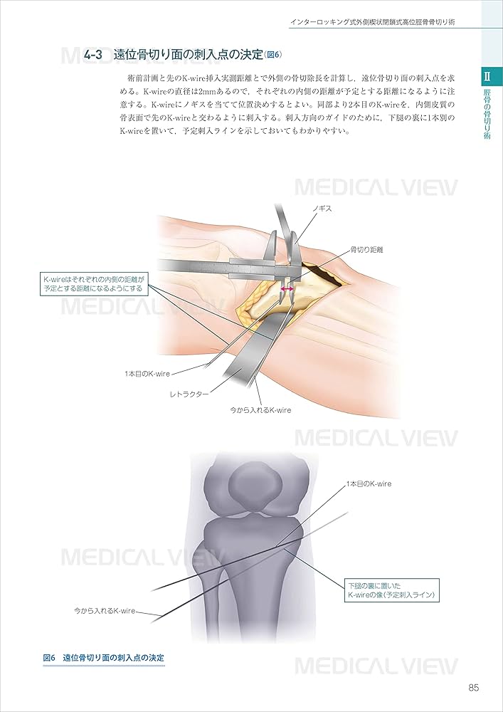 膝周囲骨切り術のすべて 膝周囲骨切り術のすべて | 岡崎 賢 |本 | 通販 | Amazon