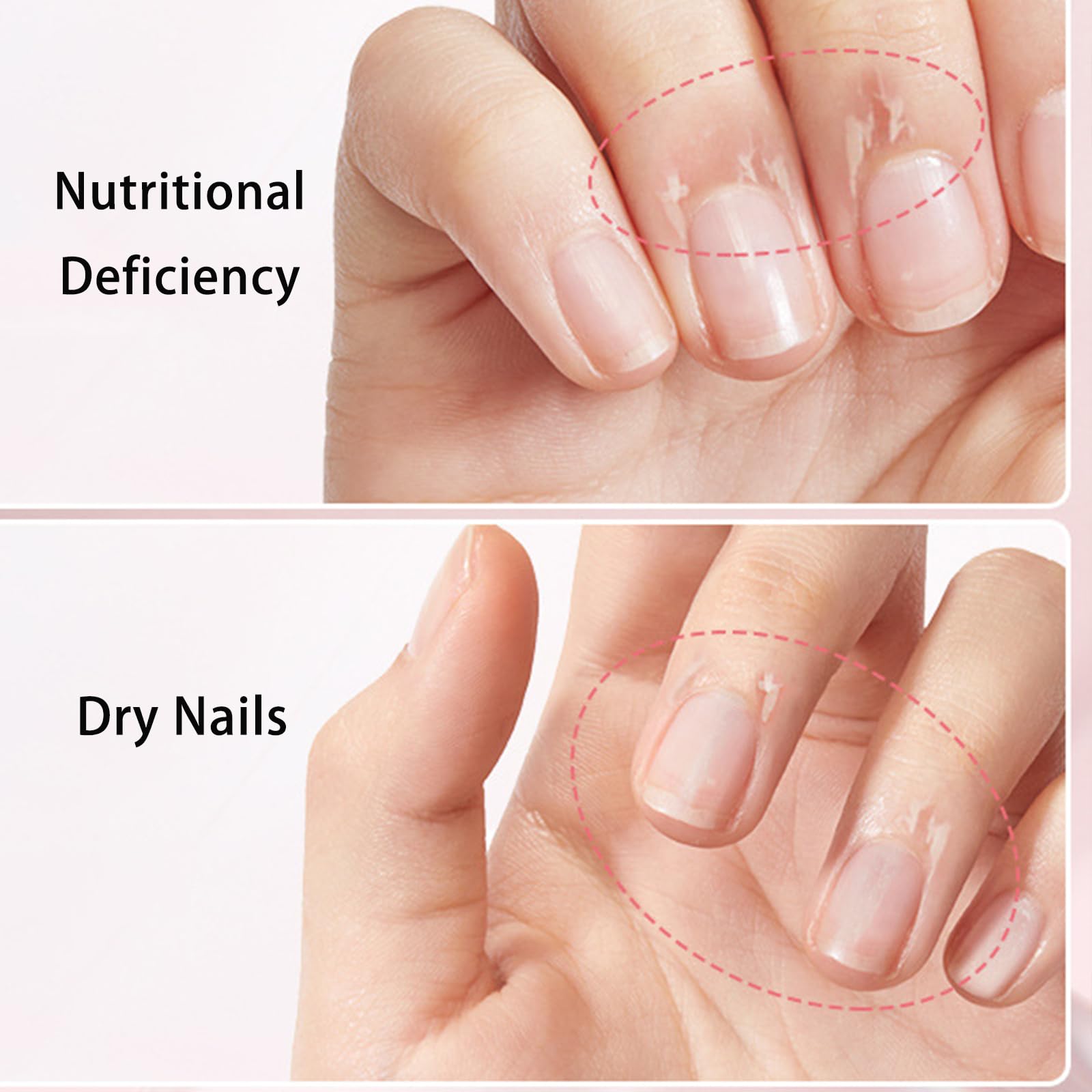 Nailz Nail Growth Pen, Anperio Stem Cell Nail Growth Pen, Radiant Nail Care, Rejuvenation Nail Repair Pen, With Lemon Tea Tree Cuticle Oil, Moisturizes And Strengthens