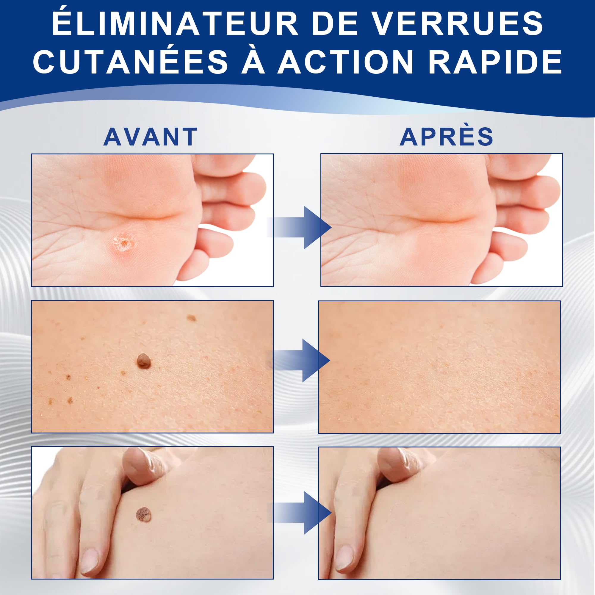 Action Enlèvement Des Acrochordons – Pipette Précision Visage & Corps | Élimination Ciblée des Verrues Plantaires, Vulgaire et Plates | Formule Douce à, Format Voyage(10ml)
