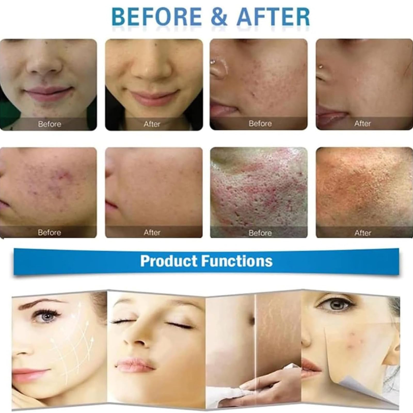 Machine Professionnelle Lifting Visage Microneedling RF Fractionné,Appareil Micro-Aiguilletage Fractionné Lifting Visage,Raffermissement Peau RF Fractionné 4 TêTes Et 2 PoignéE