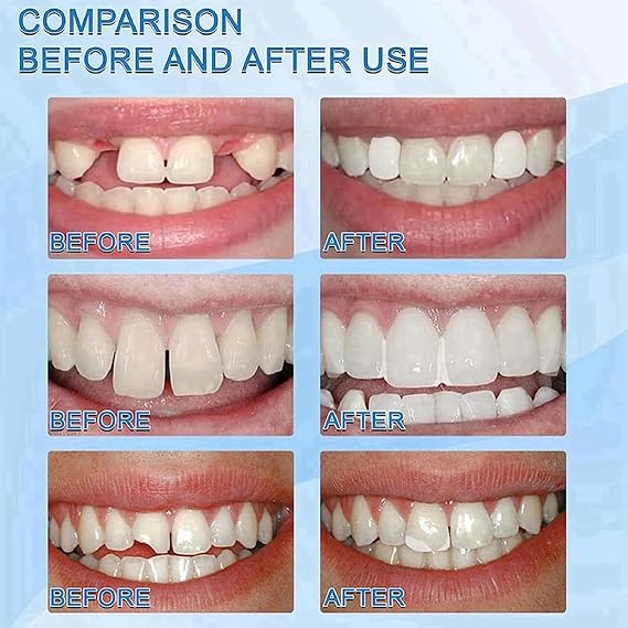 Dental Repair Kit, Temporary Tooth Filling for Lost Crowns & Broken Teeth, Moldable Thermal-Forming Material for Secure Emergency Fix