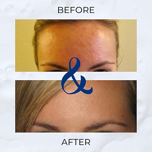 Miniatura 7 de Exfoliante facial para acné de Clear 2 Perfection - Exfoliante no comedogénico para el acné y el acné - Exfoliante corporal suave desarrollado por