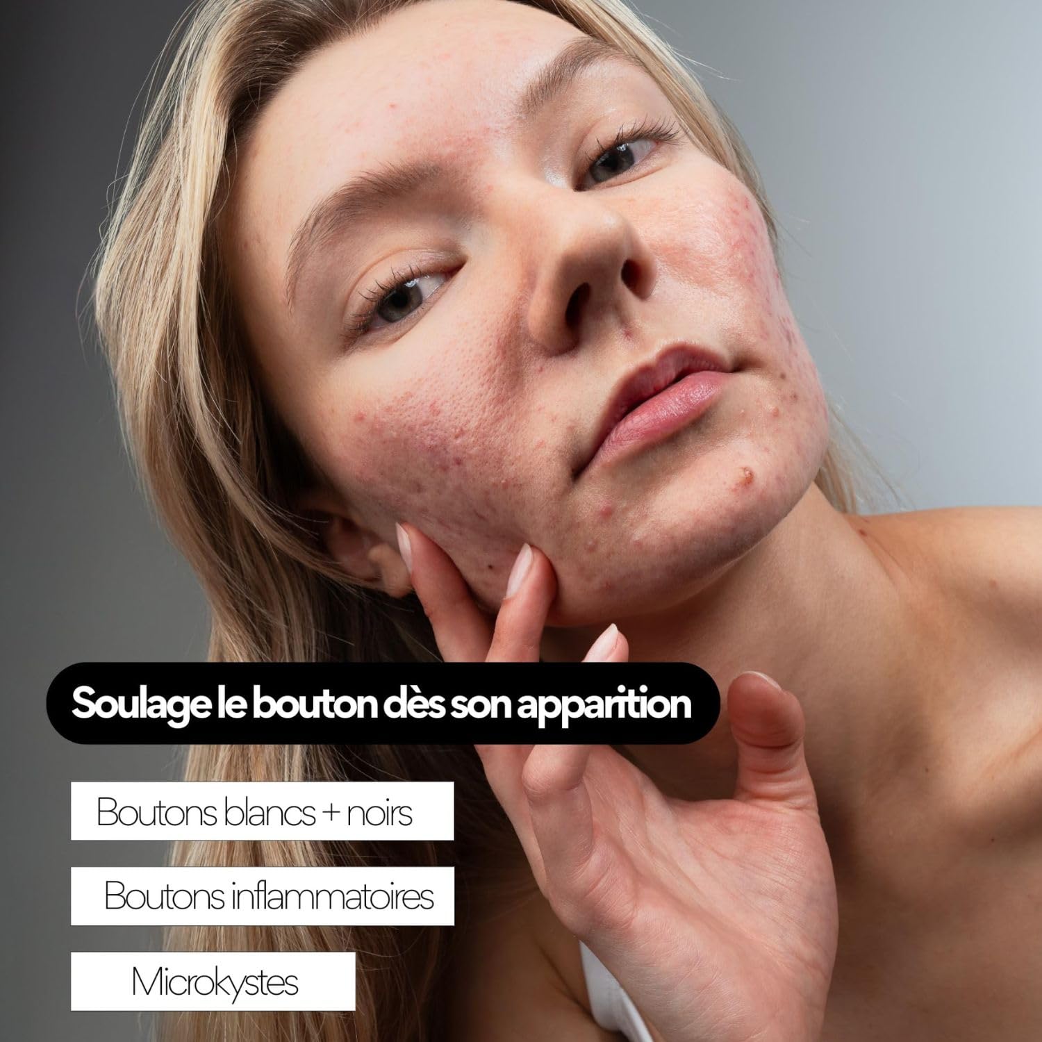 Skin & Out – Soin Boutons – 99% Naturel – Traitement ciblé stop-boutons avec Acide Salicylique 1% & Bakuchiol – Soulage les boutons, purifie et prévient l’apparition de marques post-boutons
