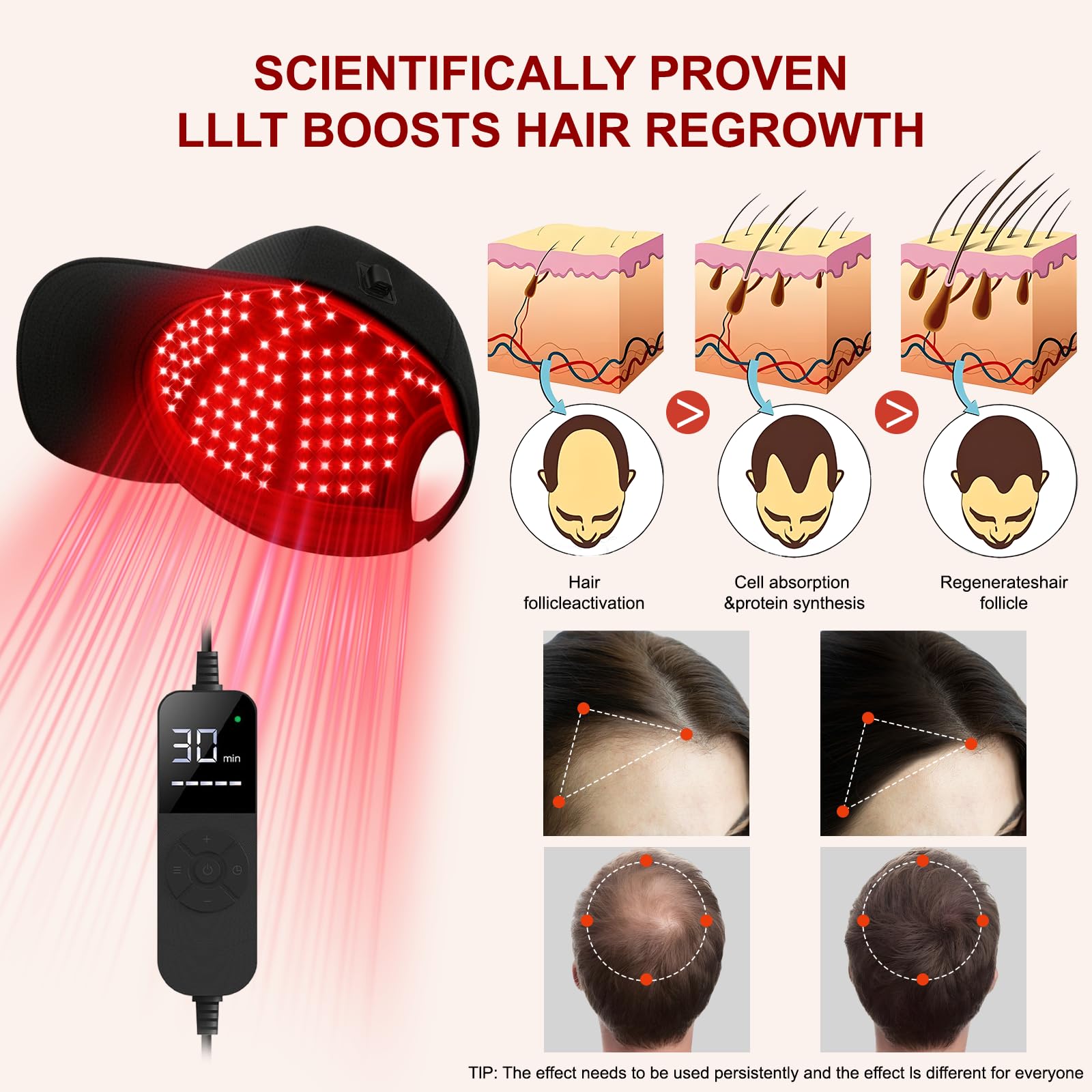 Gorra láser LLLT para crecimiento del cabello – Luz roja e infrarroja 660/850/940 nm, 5 niveles, temporizador