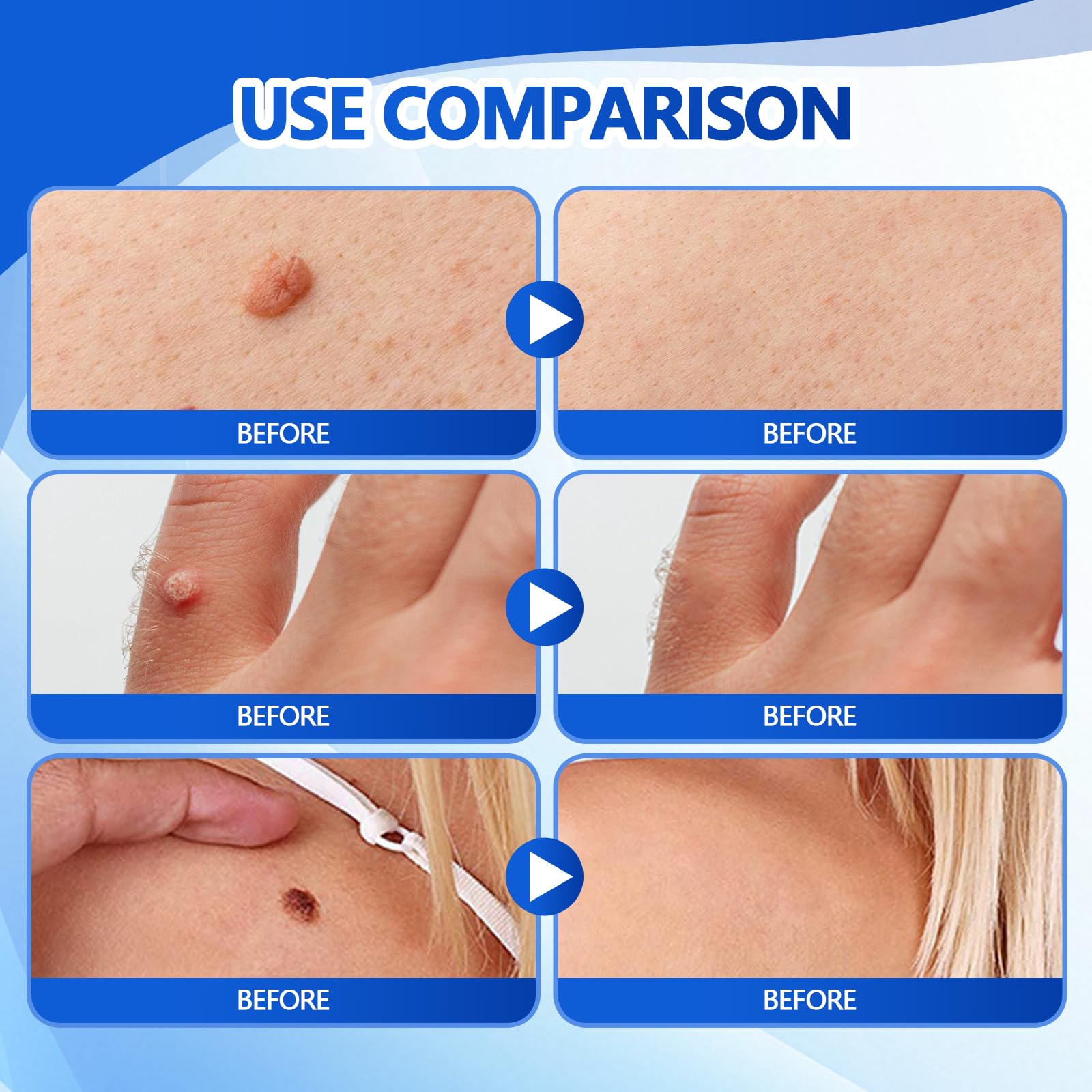 Líquido exfoliante para el cuidado de la piel 30 ml, para verrugas, mejora la textura de piel áspera y protuberancias cutáneas, uso en cara, cuello, manos y pies