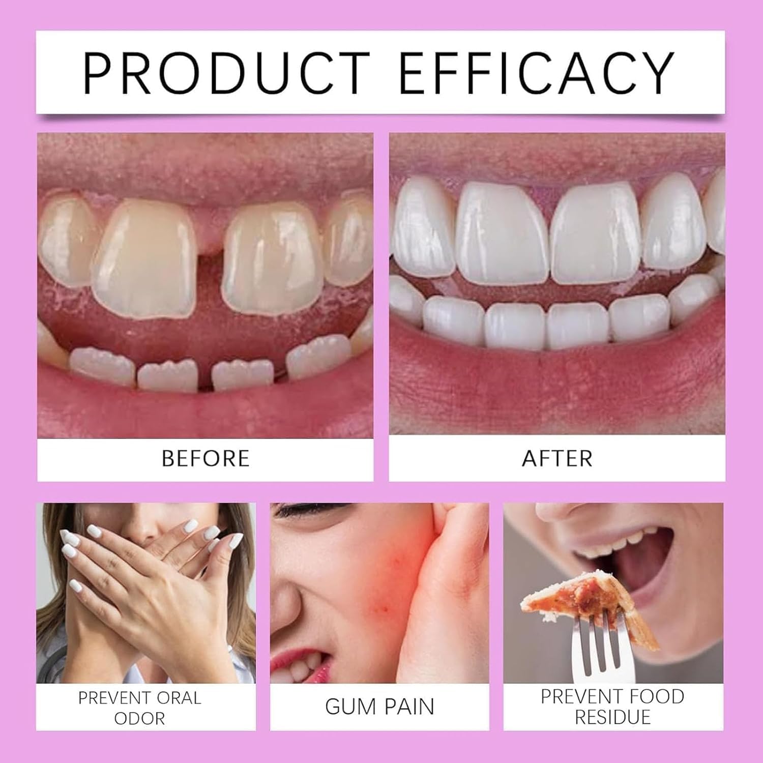 Protesi Dentaria, Dentiere in Silicone (Arcata Superiore e Inferiore), Morbide e Confortevoli, Faccette a Incastro (Snap-on), Denti in Silicone da Applicare sopra i Denti Esistenti (2Pezzo)