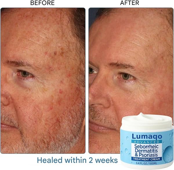 Lumaqo Crema Barba Dermatitis,Hidratación Natural,Fórmula Suave Para Pieles Sensibles Y Secas,Para Todo Tipo De Piel (2 Caja) - 2