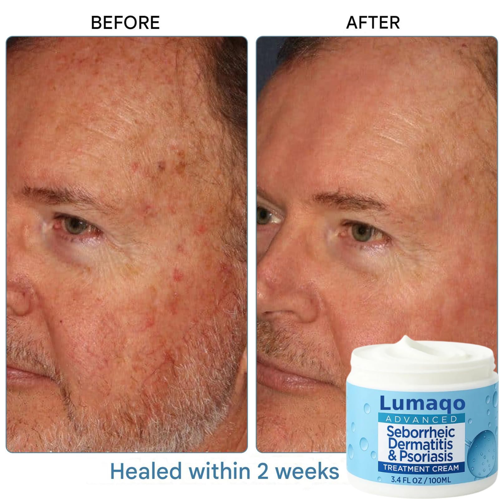 Lumaqo Crema Barba Dermatitis,Hidratación Natural,Fórmula Suave Para Pieles Sensibles Y Secas,Para Todo Tipo De Piel (3 Caja) - 2