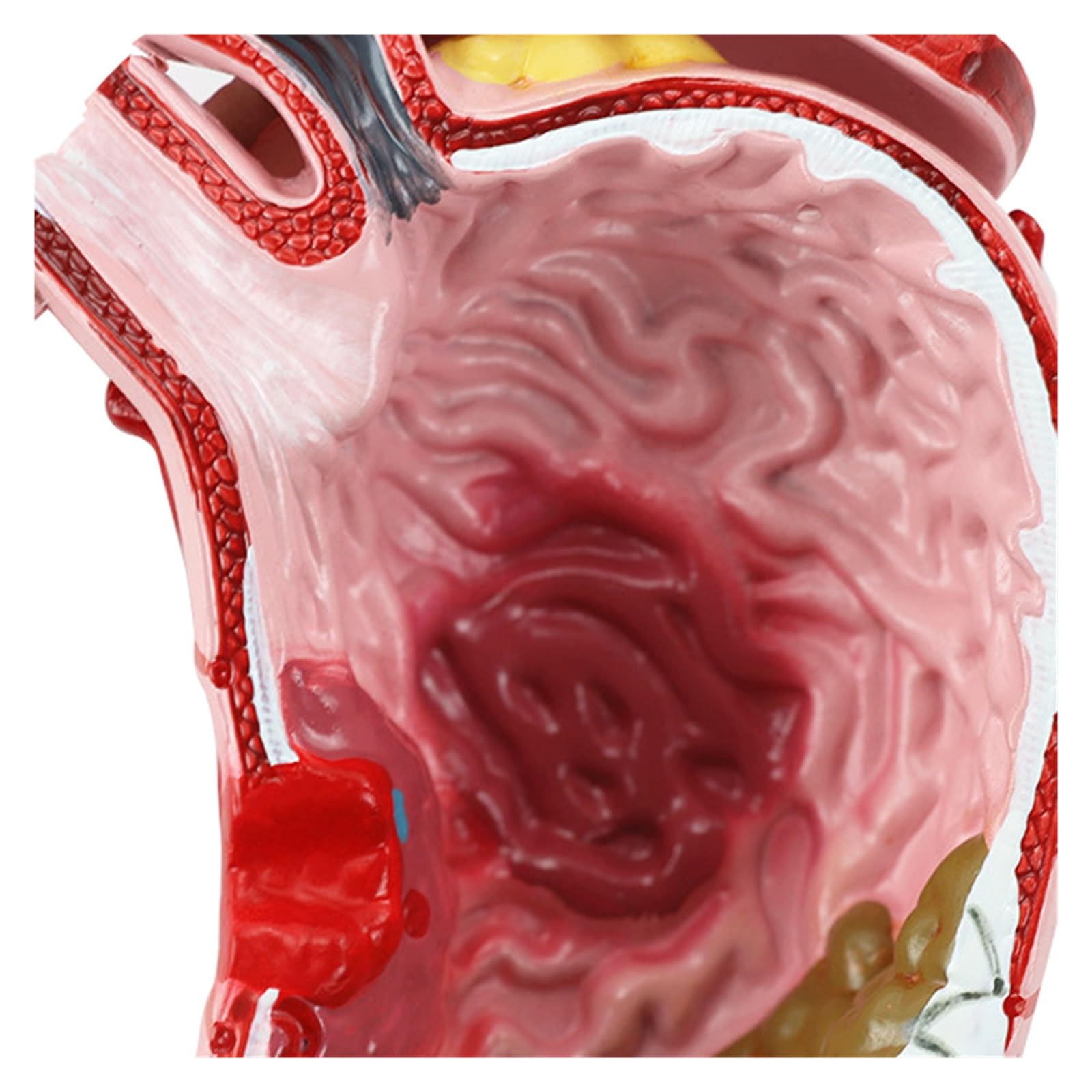 Humano EN Anatomía estomacal patológica Modelo de demostración del estómago Ayuda médica SIDA