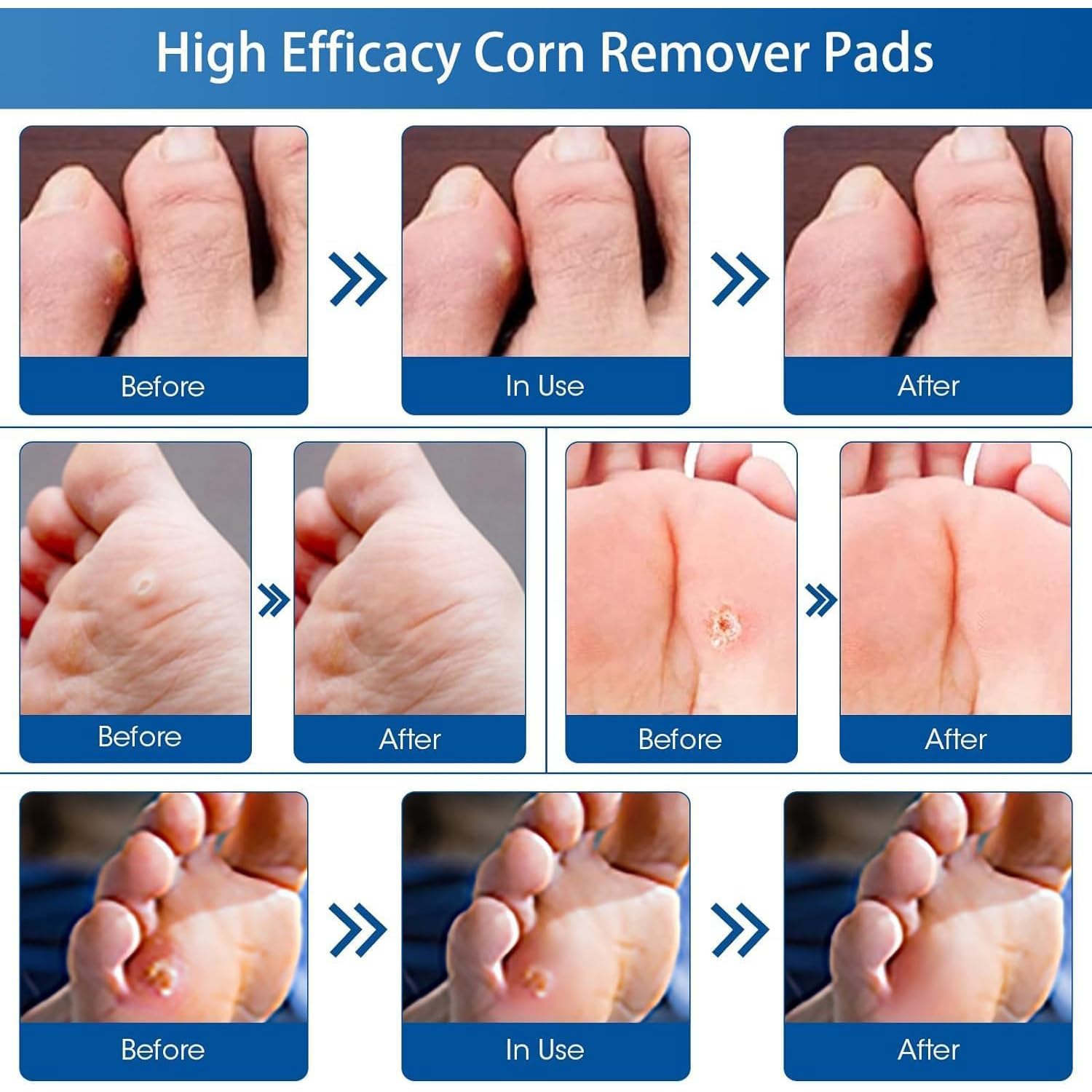 36 Parches Quita Callos y Verrugas, Eliminador de Ojo de Gallo y Callos Pies, Callicida con Almohadillas Protectoras para Eliminar Durezas y Verrugas Plantares, 36 Unidades