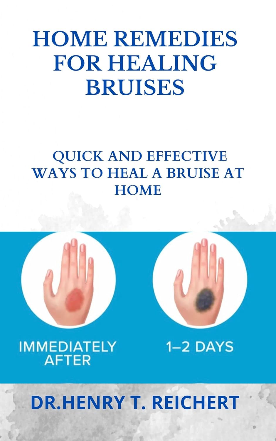 HOME REMEDIES FOR HEALING BRUISES QUICK AND EFFECTIVE WAYS TO HEAL A
