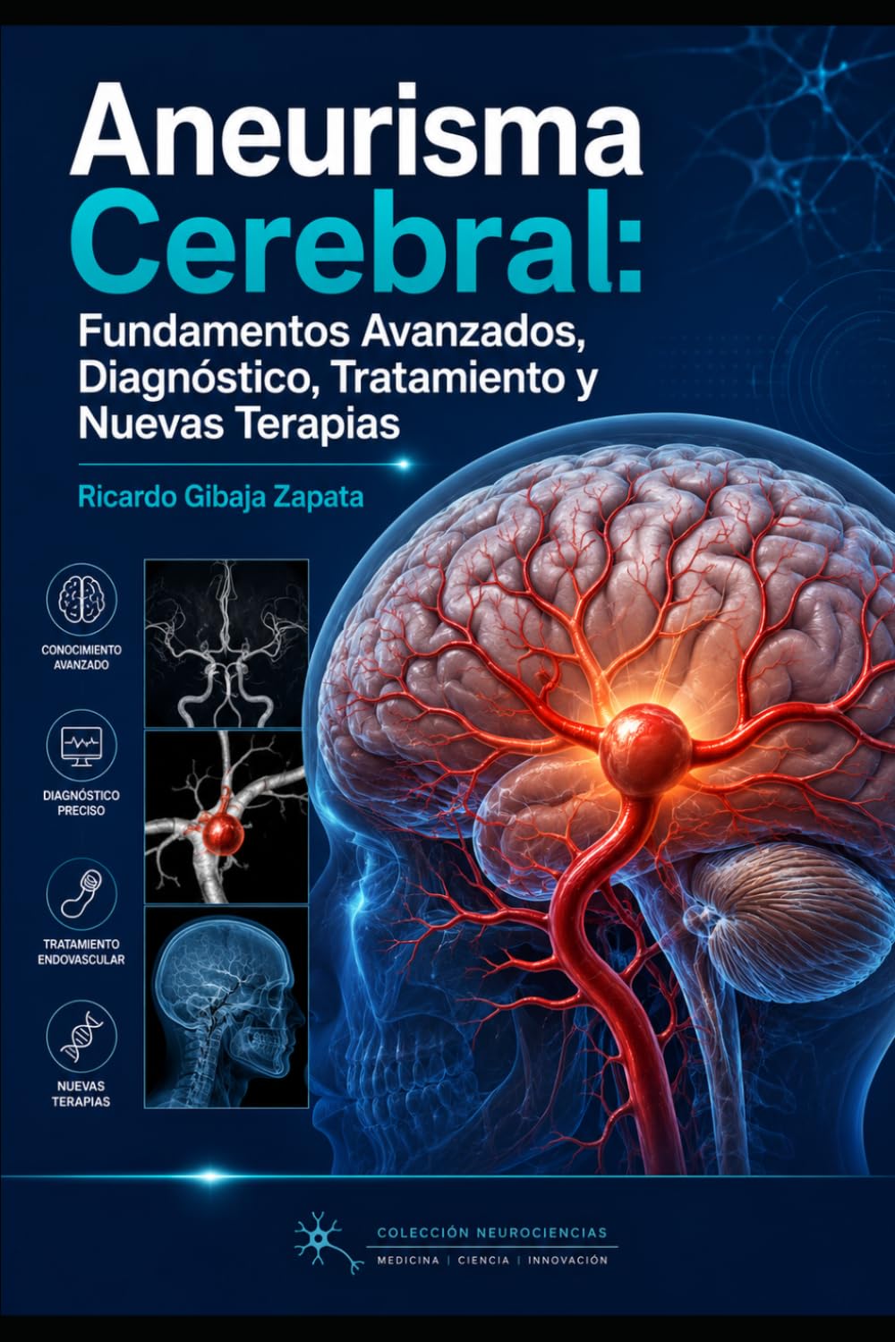 Aneurisma Cerebral Fundamentos Avanzados, Diagnóstico, Tratamiento y Nuevas Terapias