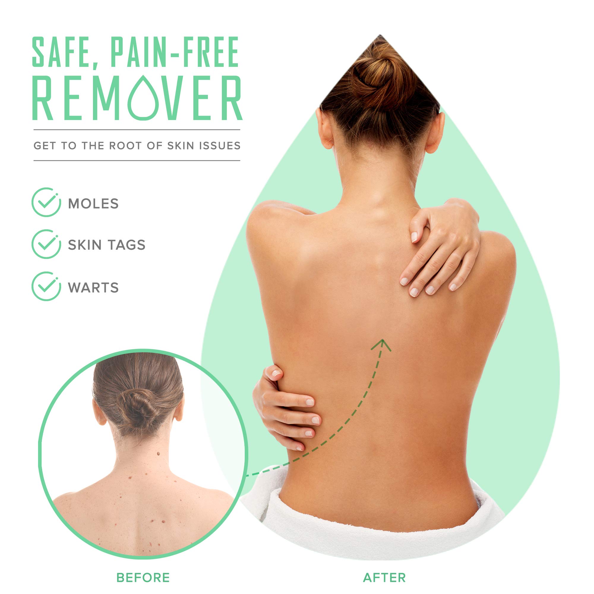 Instaderm Skin Tag and Mole Remover and Corrector, Fast Acting Medical