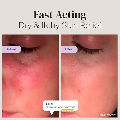 Miniatura 3 de Puriya Crema Aceptada por la Asociación Nacional de Eczema 2 oz, Alivio para Piel Seca y con Picazón, Loción de Avena Coloidal, Para Niños, Adultos,