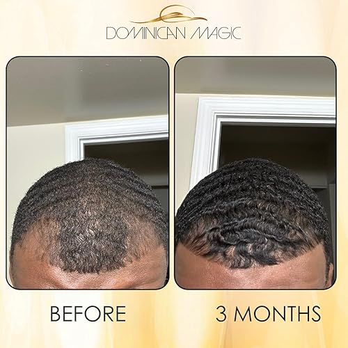 Miniatura 7 de Dominican Magic Folículo piloso antienvejecimiento para el cuero cabelludo tónico capilar con romero y canela, Gotero Anti-Caida, ayuda a estimular