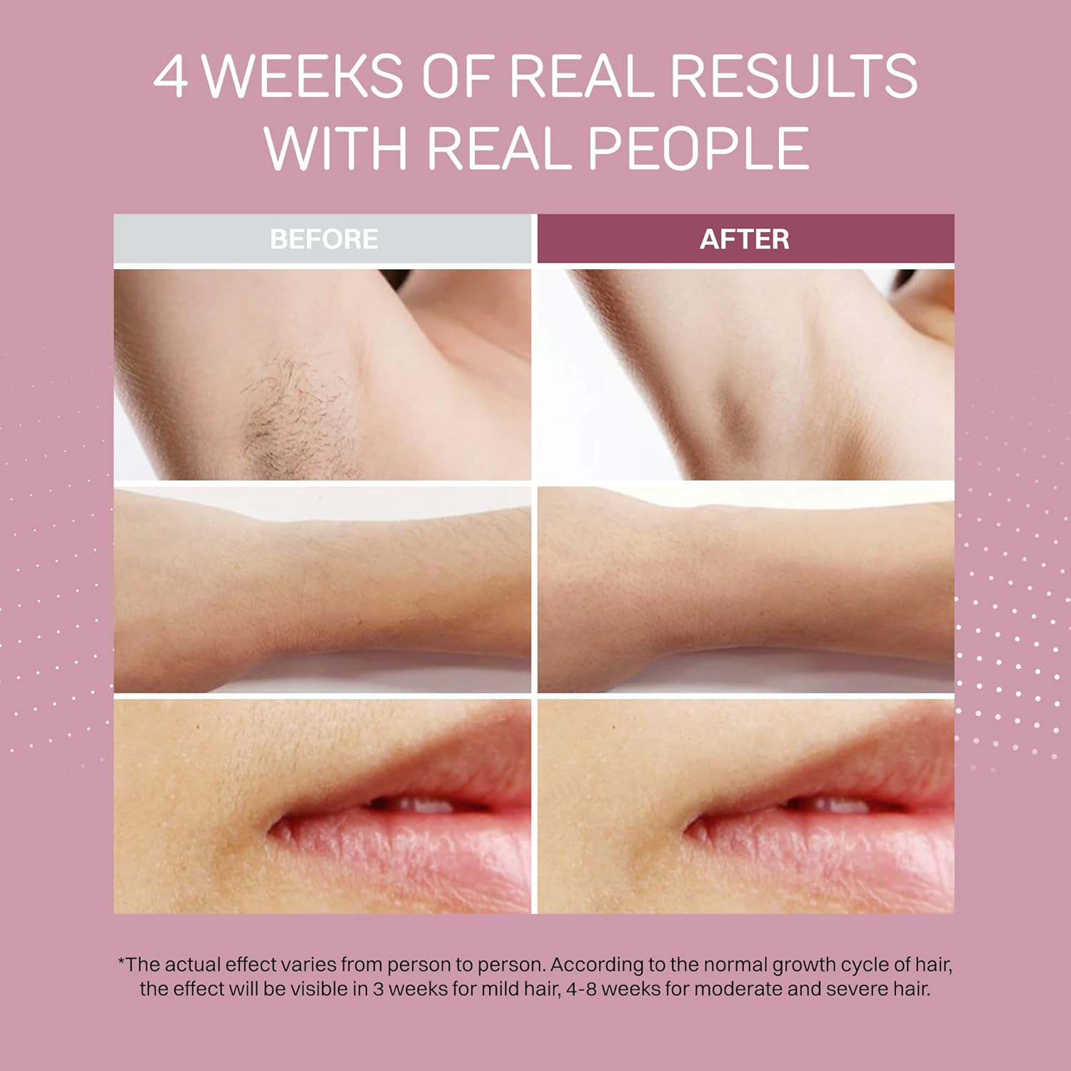 Lumina NRG IPL Hair Removal Flasher Device for Women & Men – Cordless Home Beauty Tool for Body, Face & Bikini Area – Cooling Handheld Design