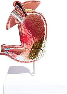 Study Model Stomach Anatomy Model Gastritis Model Gastric Lesion Model - Gastric Diseases Demonstration Human Digestive System MéDical Teaching Anatomical Model SaiFei