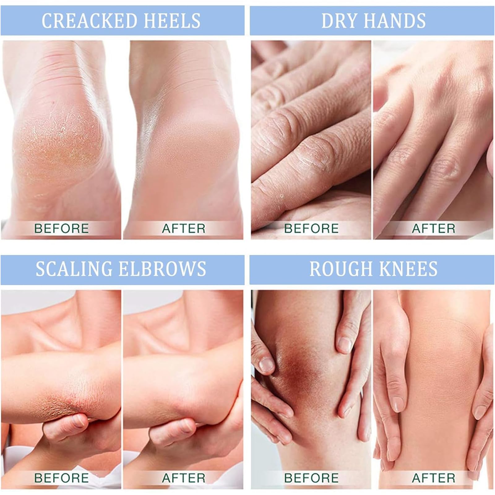 Crema Urea 40% per Piedi,Talloni,Mani e Gomiti,150g Crema Riparatrice per Pelle Secca e Screpolata,Anti Calli,Idratante Intensa per Talloni Screpolati e Piedi Molto Secchi