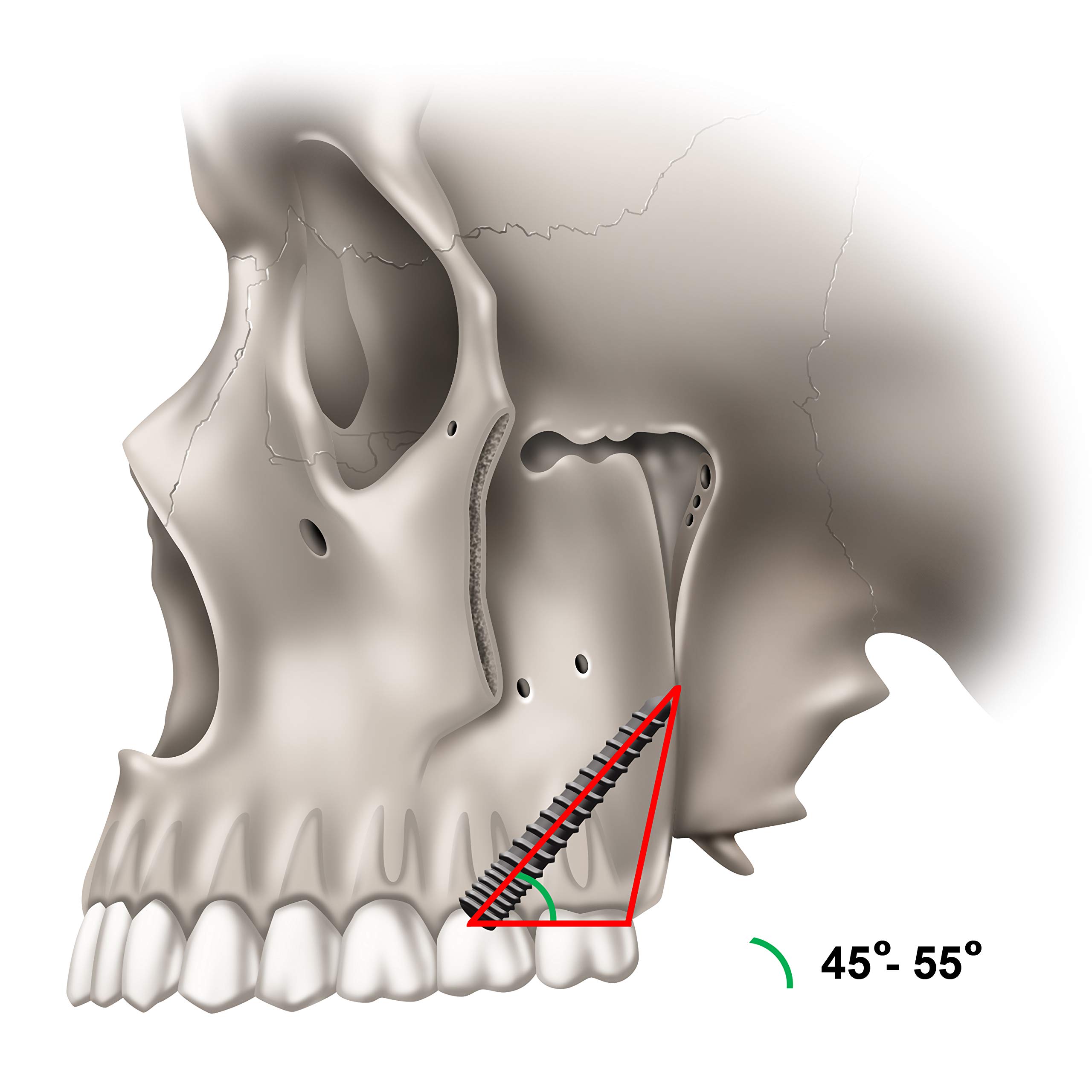 Pterygoid Implants: The Art and Science product thumbnail 8