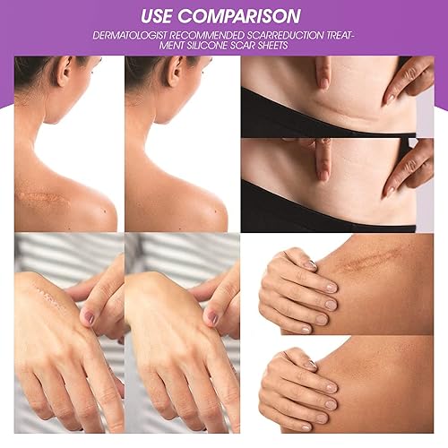 Miniatura 4 de Hojas de silicona para cicatrices para el cuidado de la piel, parche avanzado para eliminar cicatrices, suaviza y aplana cicatrices resultantes de