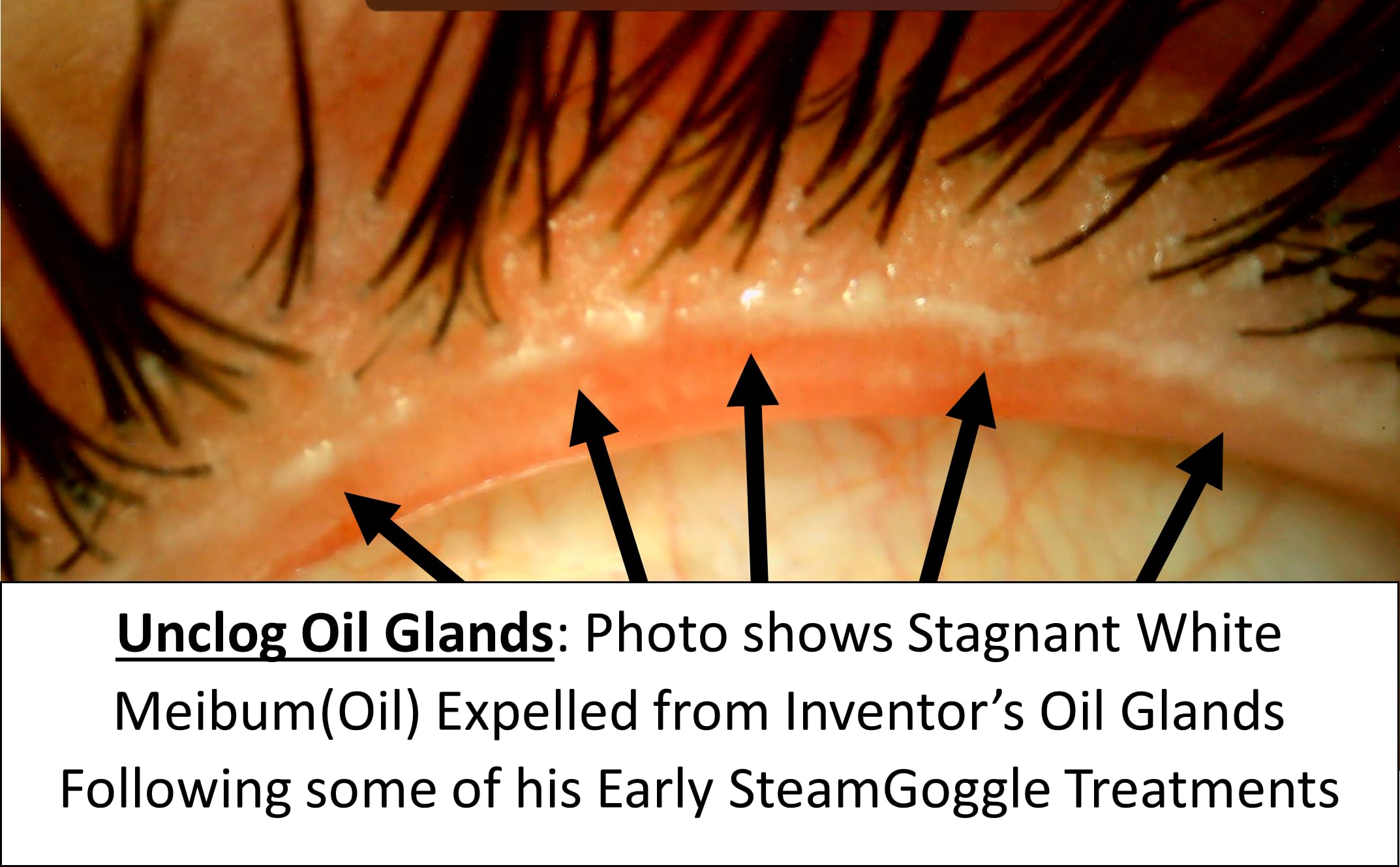 SteamGoggle-Powerful New Dry Eye/Stye Treatment (FSA-HSA), View Phone/TV During Moist Heat Treatment, Effectively Unclogs Oil Glands for Relief from MGD, Blepharitis, Styes, Chalazions, Irritated Eyes — Amazon image 4