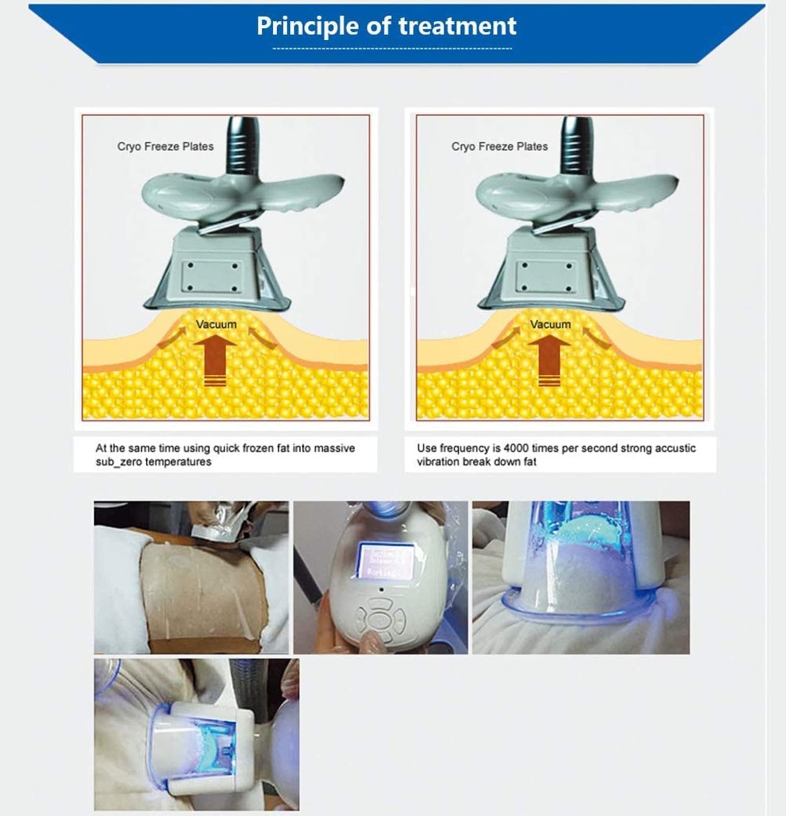 脂肪冷却マシン　Cryolipolysis 脂肪冷却マシーン・クライオ・キャビ・痩身 Cryolipolysis Amazon.co
