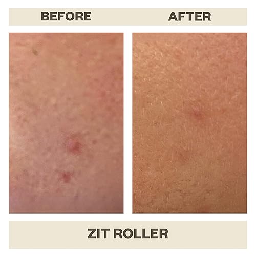 Miniatura 5 de AziMD Skincare Zit Roller - Tratamiento de manchas para el acné enrollable