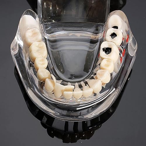Miniatura 6 de Modelos de Implantes Dentales Restauración Typodont Dientes Modelo Demostración Oral Patología Puente Enseñar Estudio Color Claro M2001