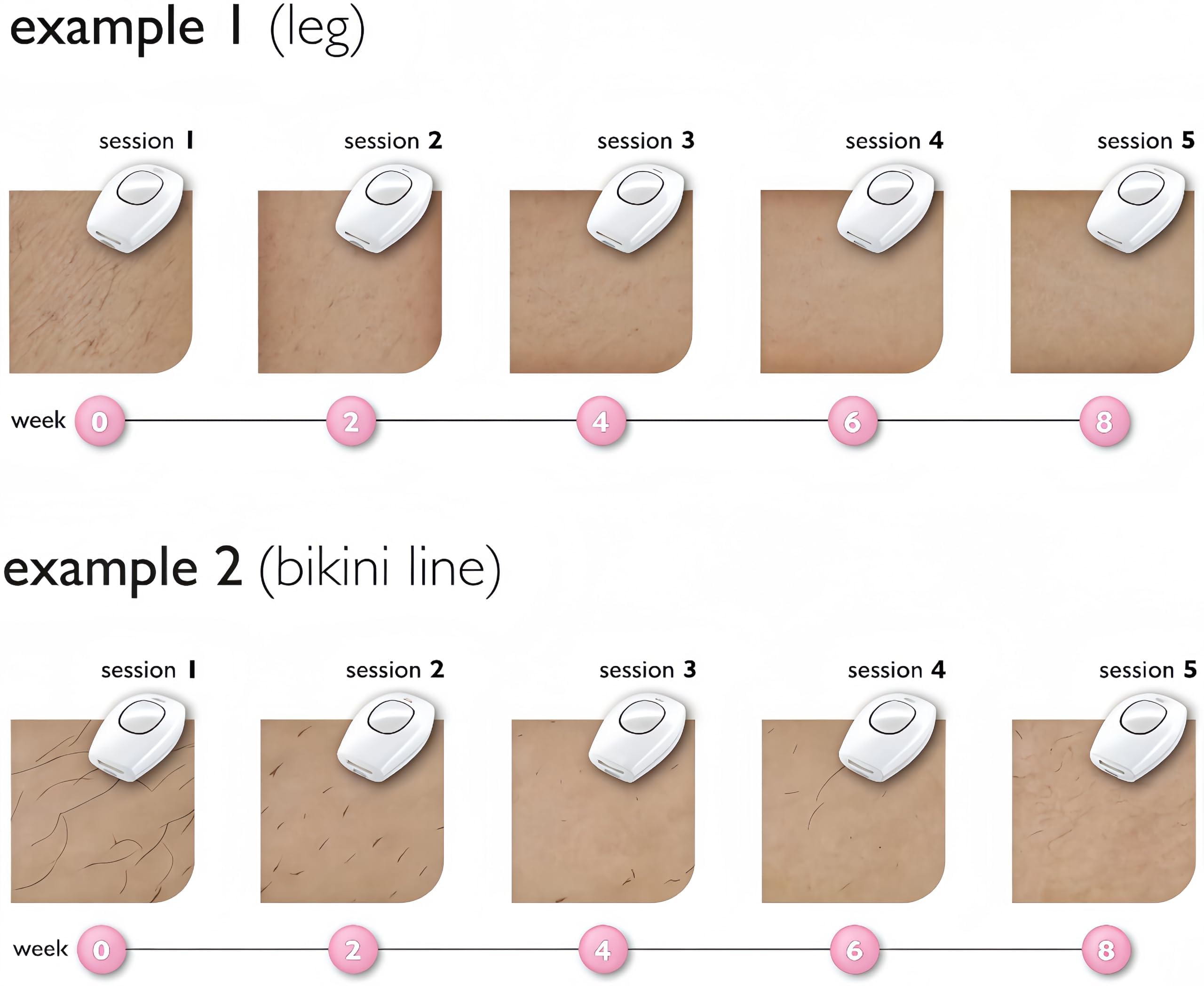 Solippy Loop Epilateur Laser,2026 Loop De Solippy Epilateur Ipl,Épilation Laser Indolore,Pour Épilation Définie Du Visage, Corps, Bikini Et Aisselles (Blanc)